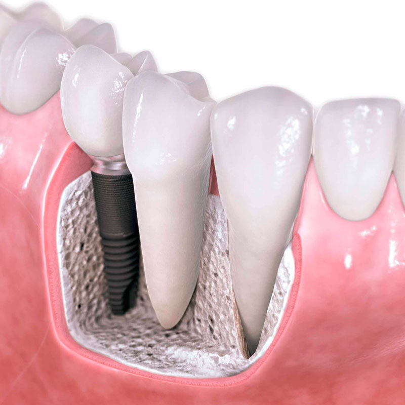 ცოტა რამ იმპლანტაციის შესახებ 